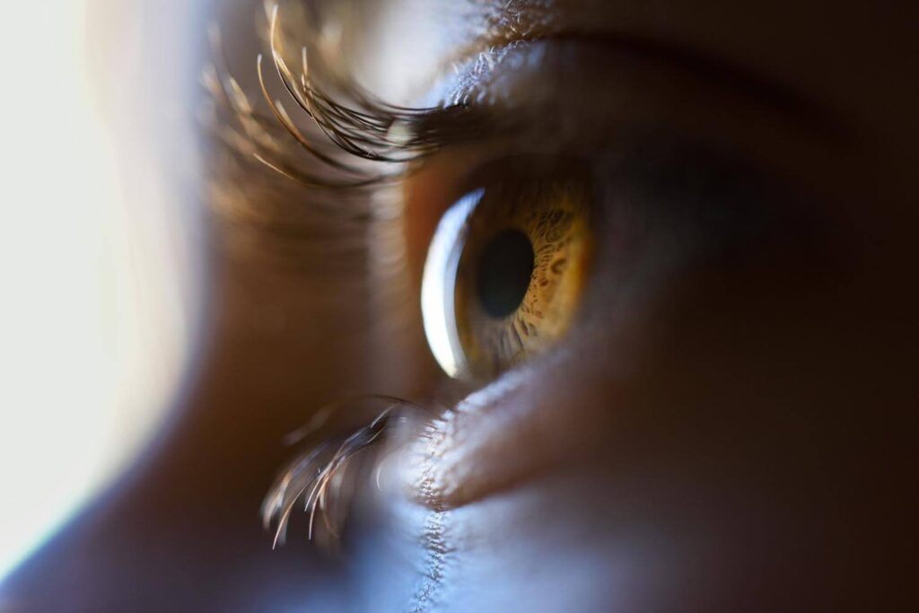 keratoconus